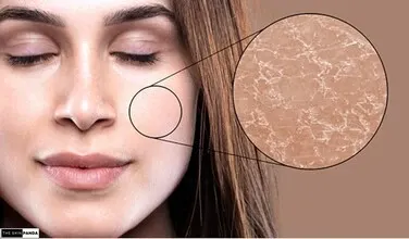 Difference Between Dehydrated and Dry Skin