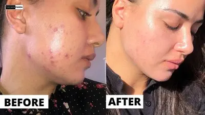 Before Using Tretinoin