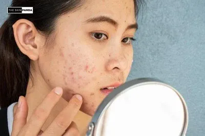 Navigating Challenges and Side Effects of Tretinoin