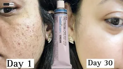 The Transformation: After Effects of Tretinoin