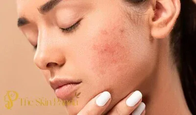 Anti-Inflammatory and Soothing Effects