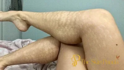 Common Side Effects and Risks of Laser Hair Removal
