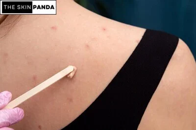 Common Skin Issues Addressed by Sulfur