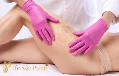 Does Laser Hair Removal Cause Skin Cancer