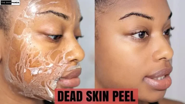 Removing Dead Skin After Chemical Peel