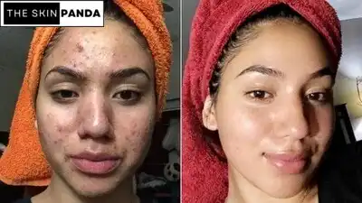 Skincare Routine for Teenage Acne